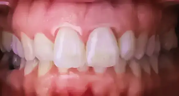 Corone1-extra